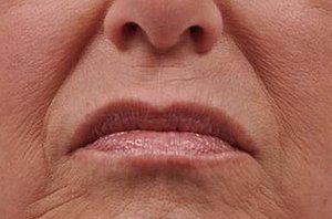 What are Nasolabial Folds?