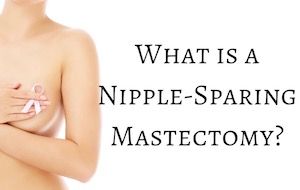 Nipple Sparing Mastectomy and Breast Reconstruction