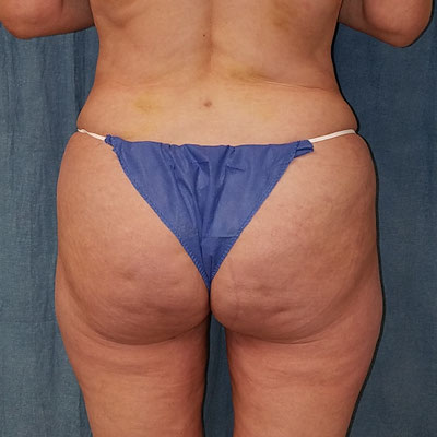 Fat Transfer To Butt Before And After Patient 5