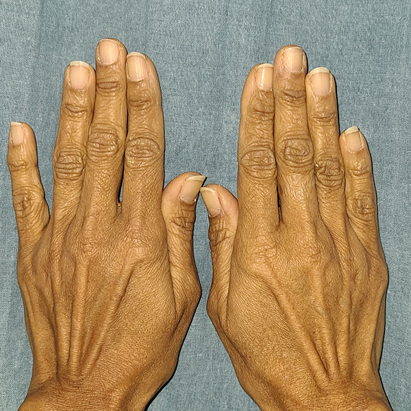 Fat Transfer In Hands Before & After Image