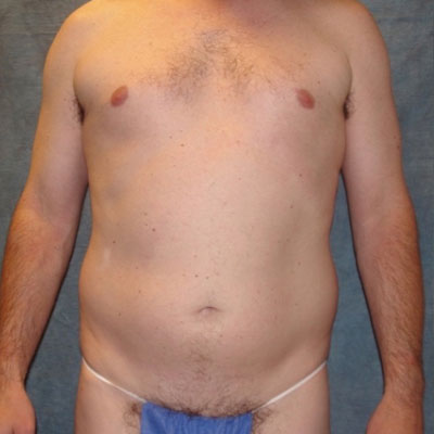 Liposuction for Men Before & After Image