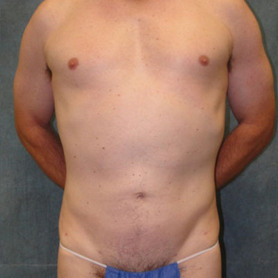 Liposuction for Men After Photo