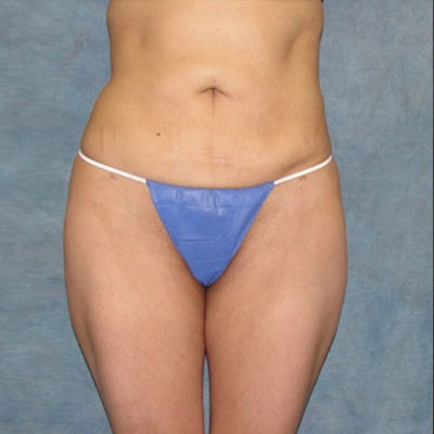 Liposuction Before and Afters patient 1