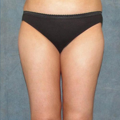 Liposuction Before and Afters patient 6