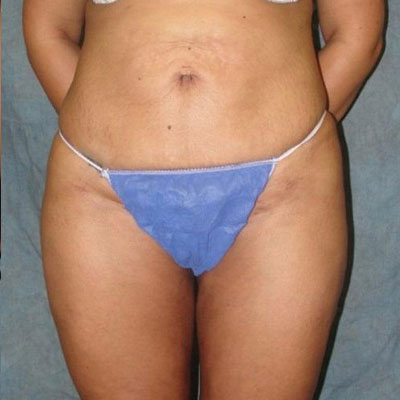 Liposuction Before and Afters patient 8