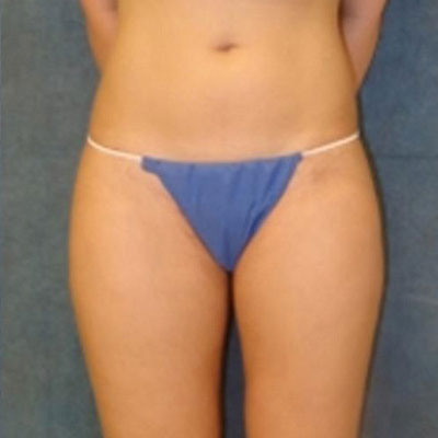 Liposuction Before and Afters patient 11
