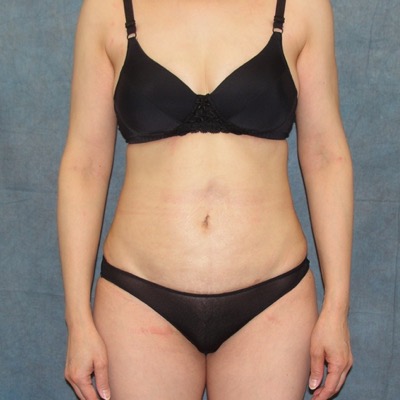 Liposuction Before and Afters patient 12