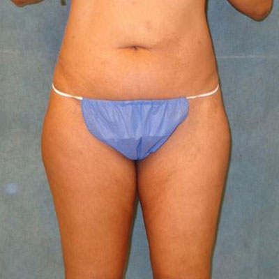 Liposuction Before Photo