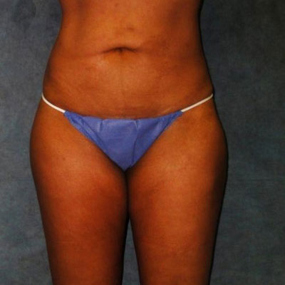 Liposuction Before and Afters patient 16