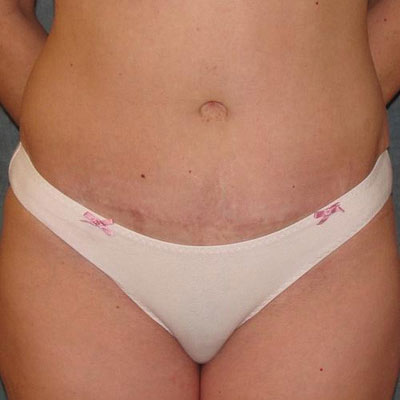 Tummy Tuck Before and After Patient 1