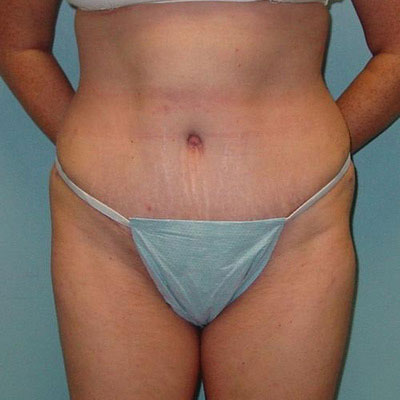 Tummy Tuck Before and After Patient 2