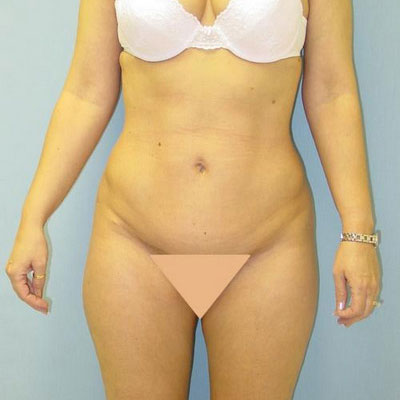 Tummy Tuck Before and After Patient 4