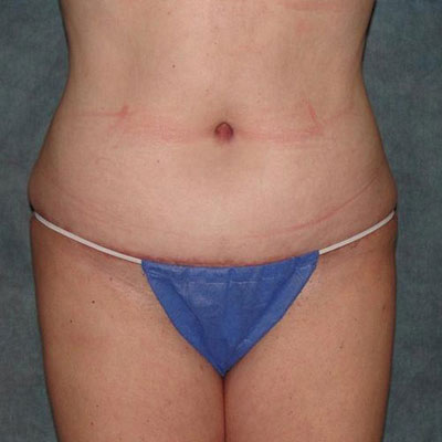 Tummy Tuck Before and After Patient 7