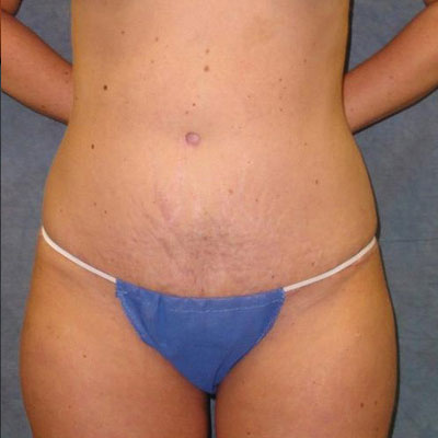 Tummy Tuck Before and After Patient 13