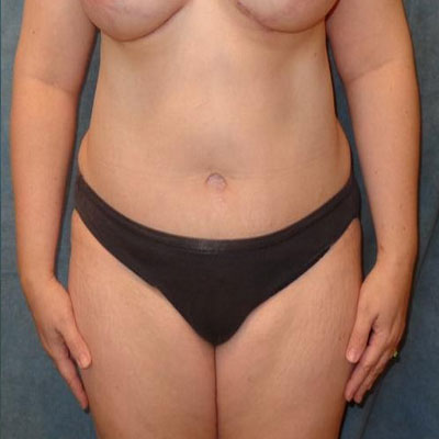 Tummy Tuck Before and After Patient 16