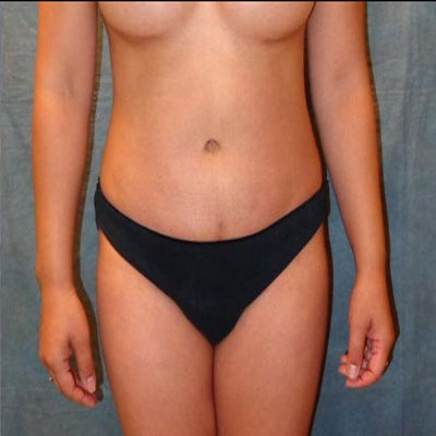 Tummy Tuck Before and After Patient 17