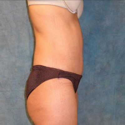 Tummy Tuck After Photo