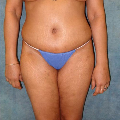 Tummy Tuck Before and After Patient 20