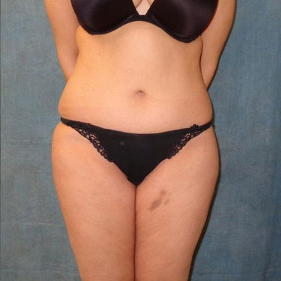 Tummy Tuck Before and After Patient 22