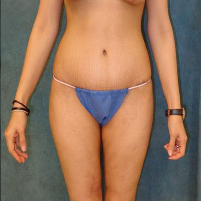 Tummy Tuck Before and After Patient 23
