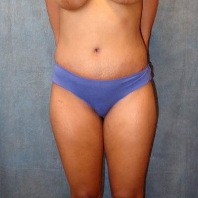Tummy Tuck Before and After Patient 27