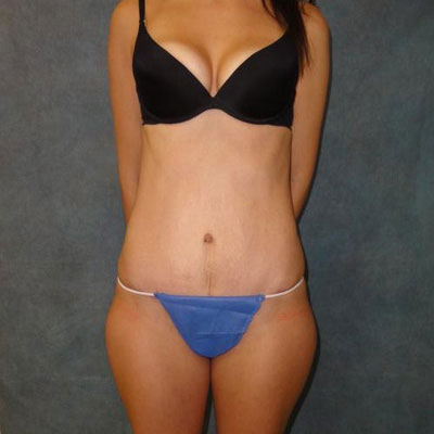 Tummy Tuck Before and After Patient 28
