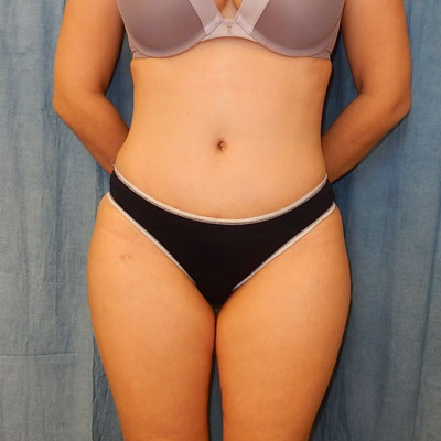 Tummy Tuck Before and After Patient 30