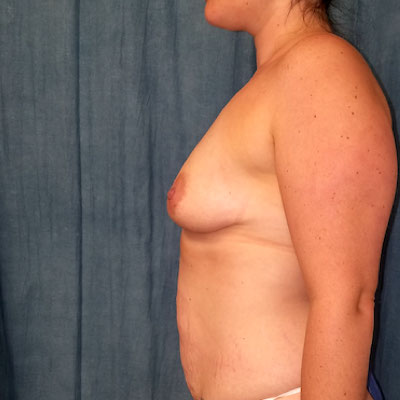 Breast Augmentation And Lift Before Photo