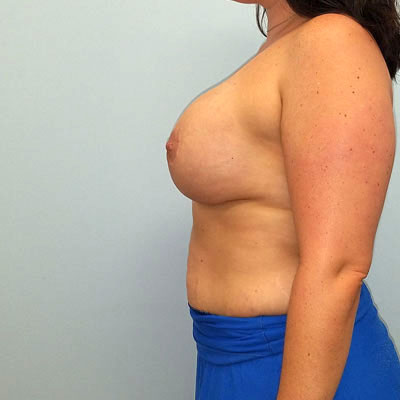Breast Augmentation And Lift After Photo