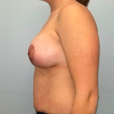 Breast Lift With Augmentation Before & After Image