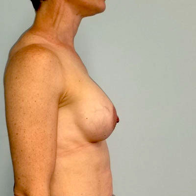 Breast Augmentation And Lift After Photo