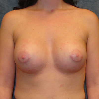 Breast Augmentation Before And After Patient 14