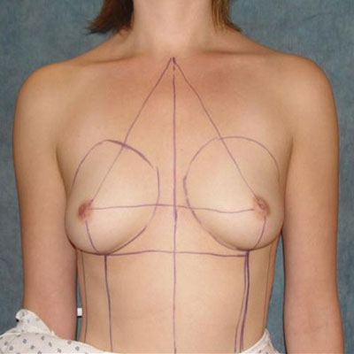 Breast Augmentation Before Photo