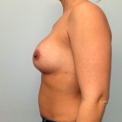 Breast Augmentation After Photo