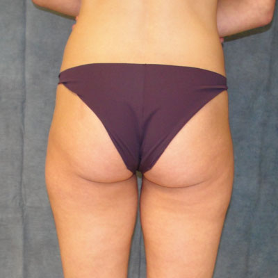 Augmentation With Fat Transfer Before & After Image