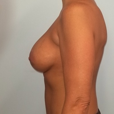 Breast Implant Replacement After Photo
