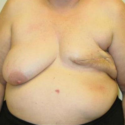 Breast Reconstruction Flap Before & After Image