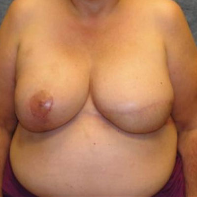 Breast Reconstruction Flap Based After Photo