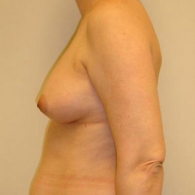 Breast Reconstruction Before Photo