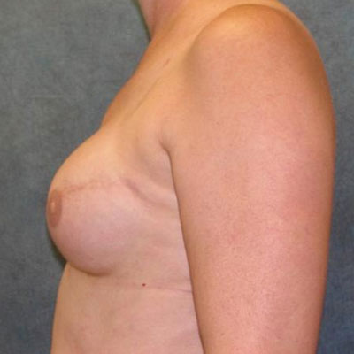Breast Reconstruction After Photo
