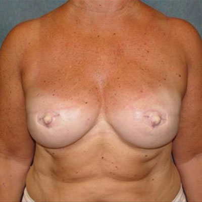 Breast Reconstruction After Photo