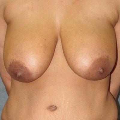 Breast Reduction Before Photo
