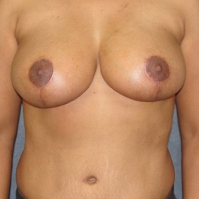 Breast Reduction before and after patient 6