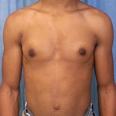 Male Breast Reduction Before and After Patient 1
