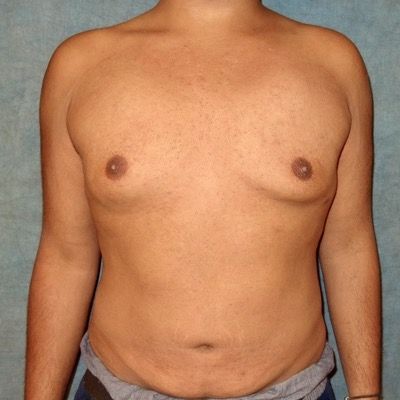 Male Breast Reduction Before and After Patient 2