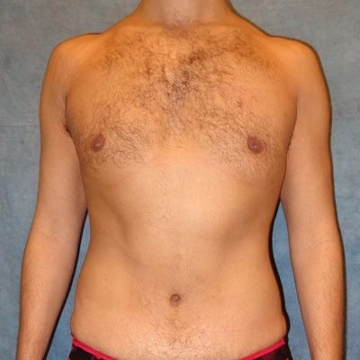 Male Breast Reduction Before and After Patient 3