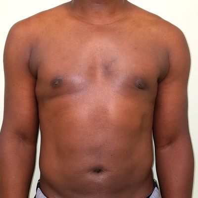 Male Breast Reduction Before and After Patient 4