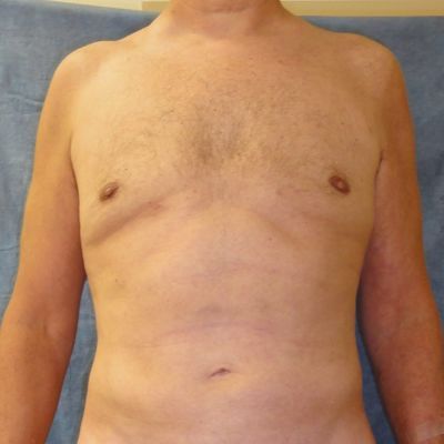 Male Breast Reduction Before and After Patient 5