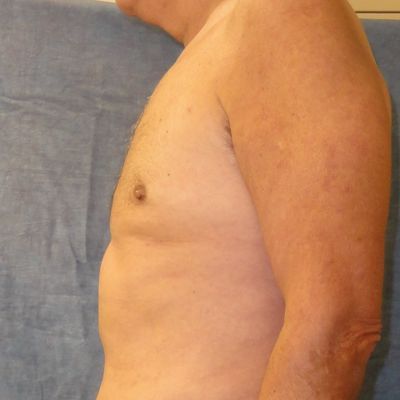 Male Breast Reduction | Gynecomastia Before & After Image