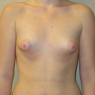 Tuberous breast augmentation before